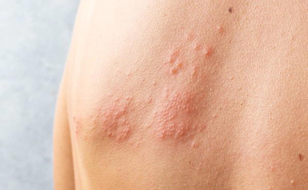 대상포진 병원 예방접종 가격 