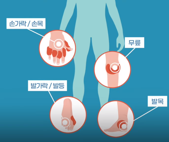 통풍 증상과 치료방법