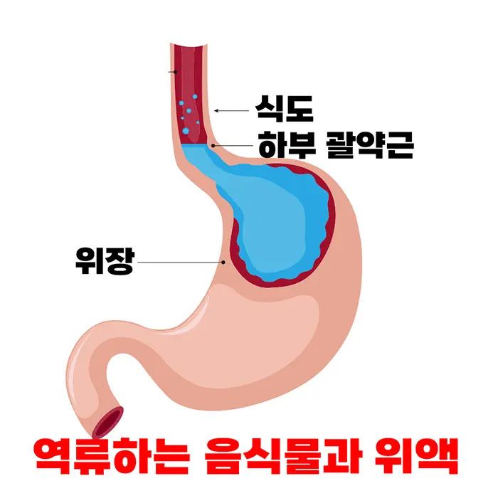 위장,위산,역류,하부괄약근,식도,역류성식도염