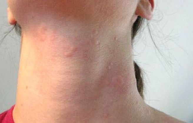 피부 발진 종류