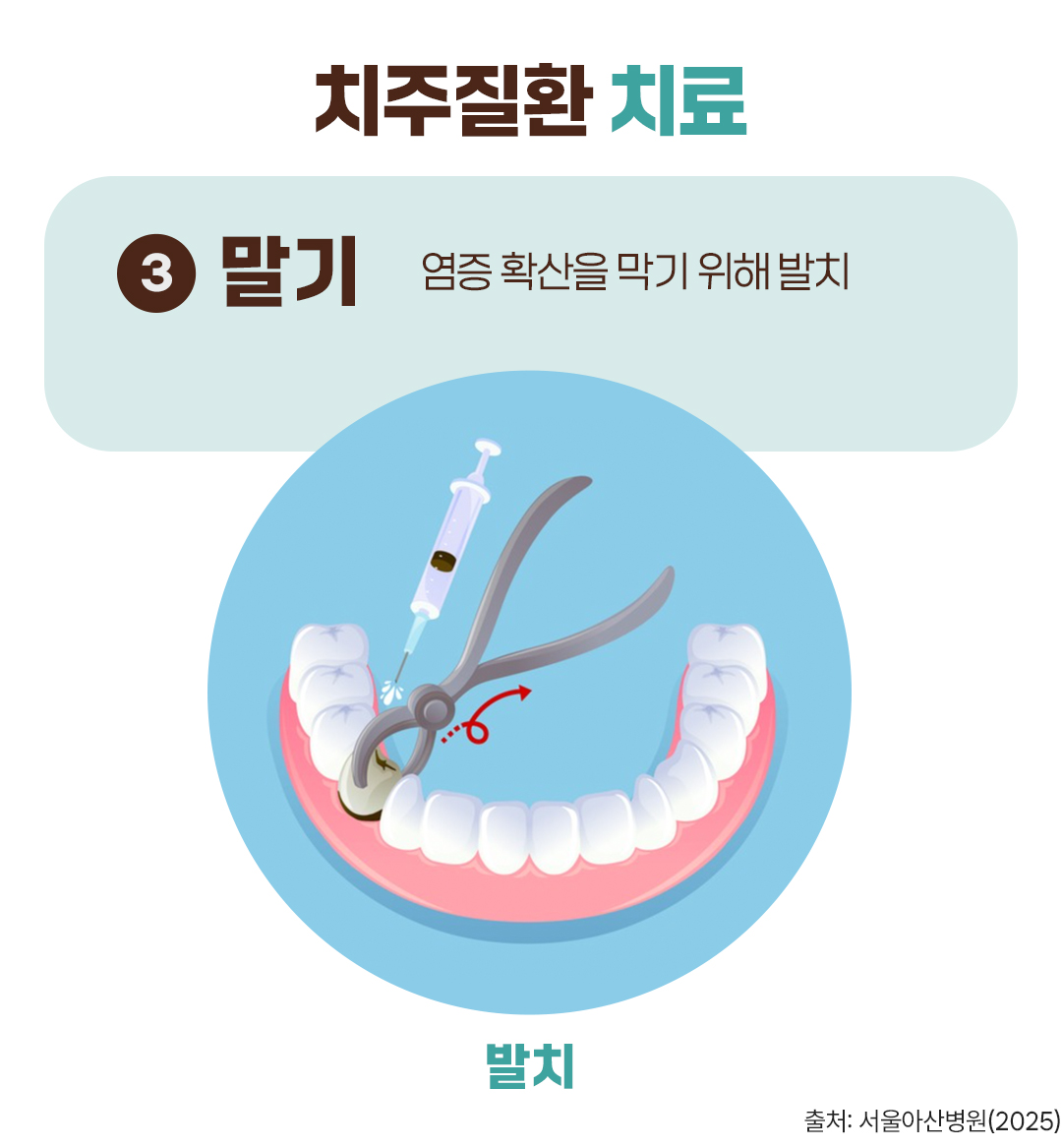 #치주질환 치료 #말기 #발치