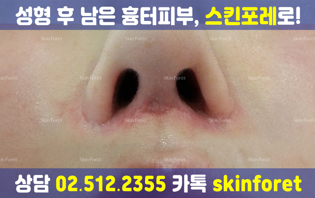 인중축소술 및 코성형 전후 부작용