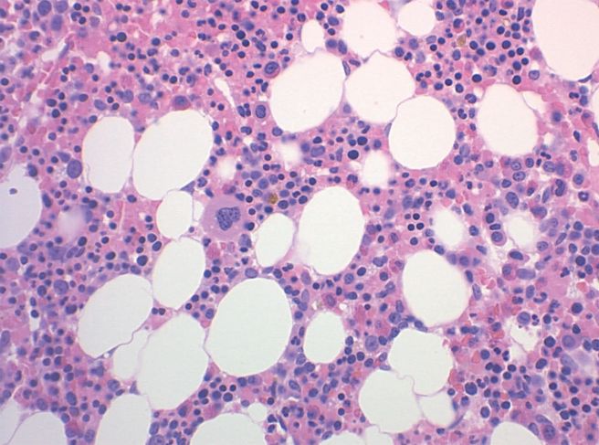 혈소판 수치가 낮으면