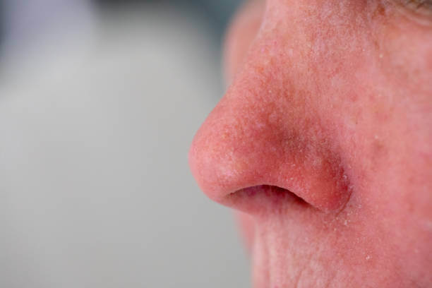 딸기코 원인과 치료비용 한눈에! 재발 방지 관리법까지 정리