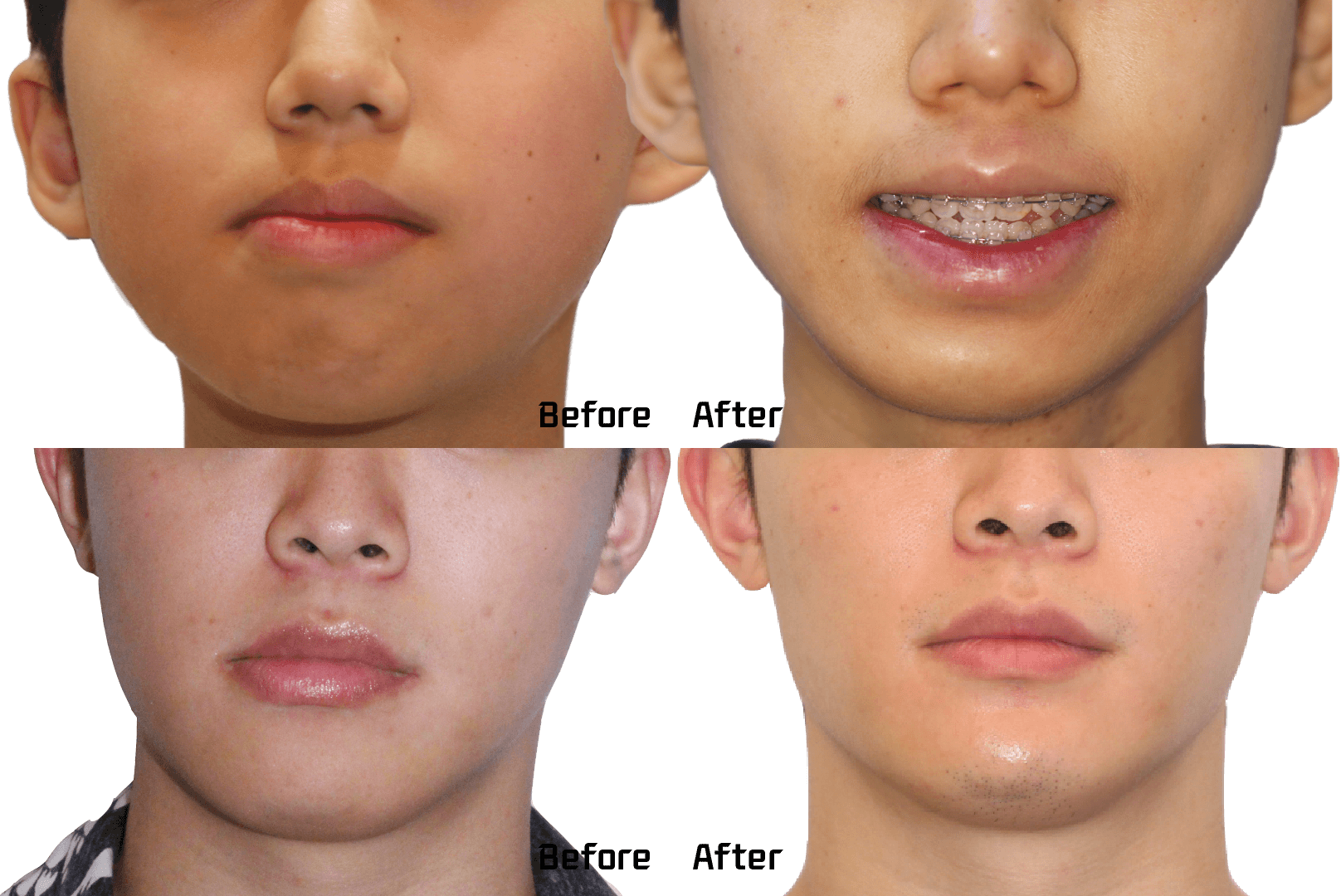 연예인-안면비대칭-교정