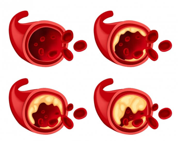 혈관 속 노폐물