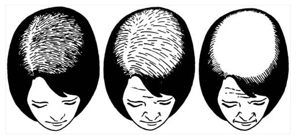 여성 탈모의 진행 모습