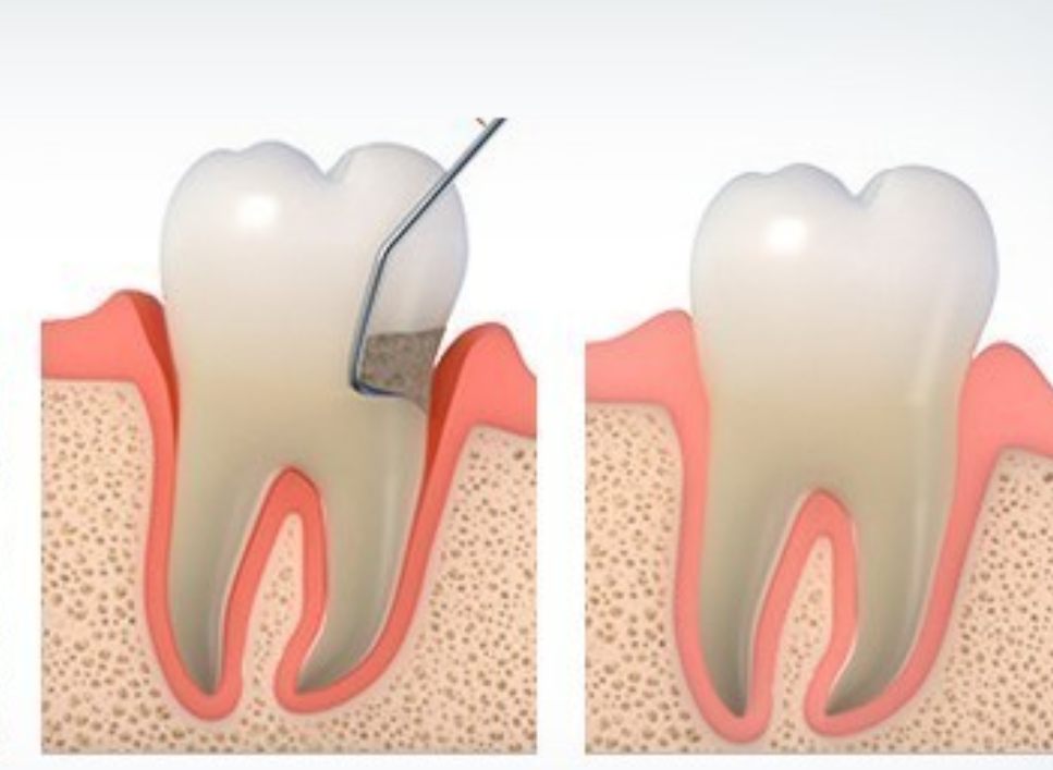 2030세대 치주치료 팁