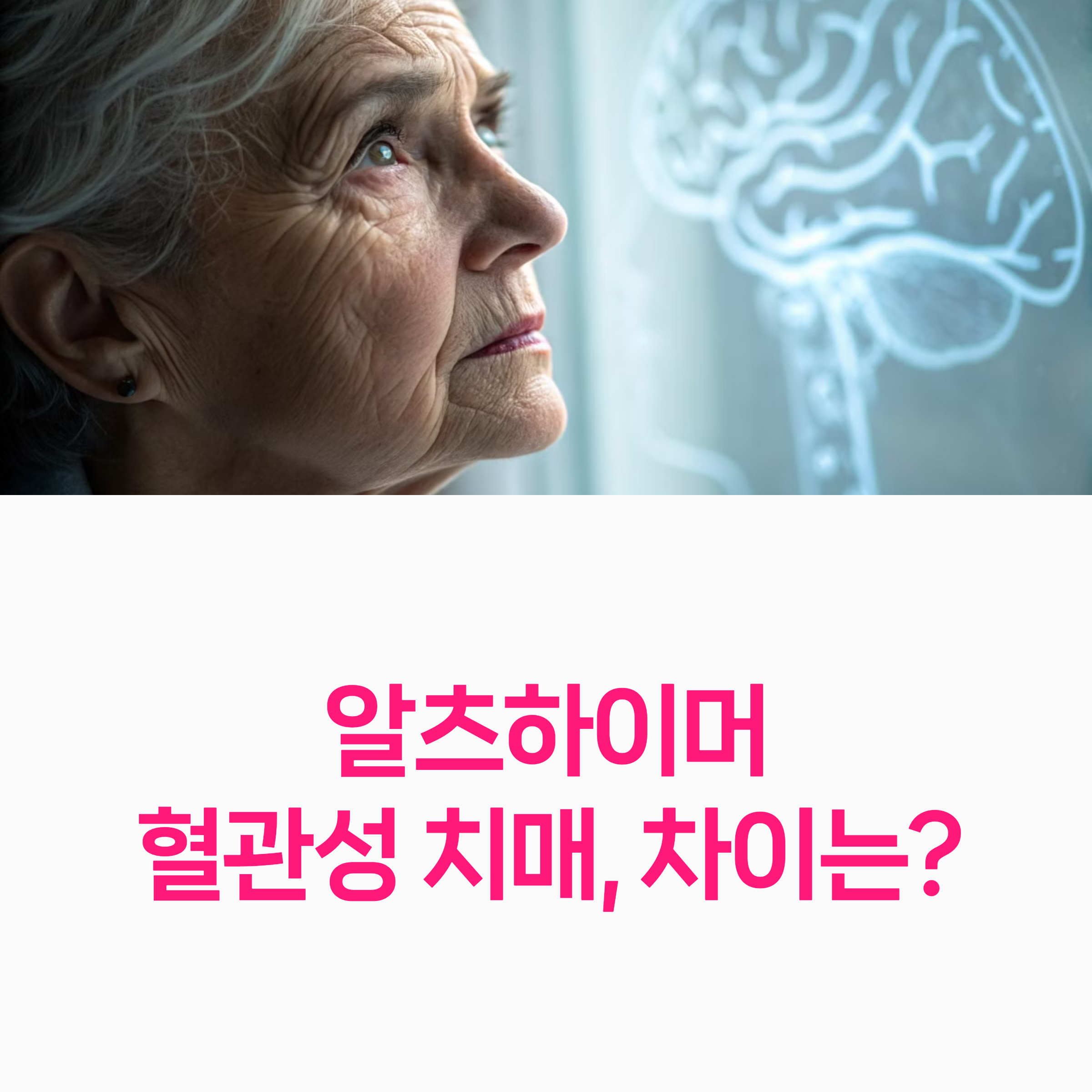 알츠하이머