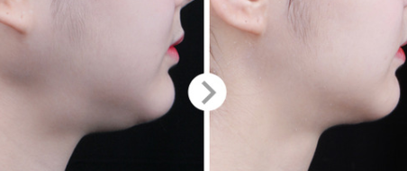 침샘보톡스2
