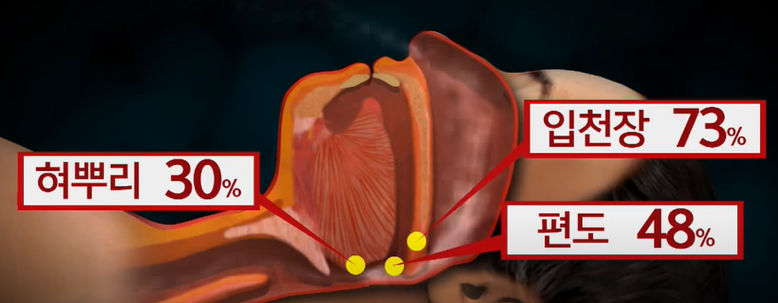 코골이의 원인이 되는 부위 세 가지