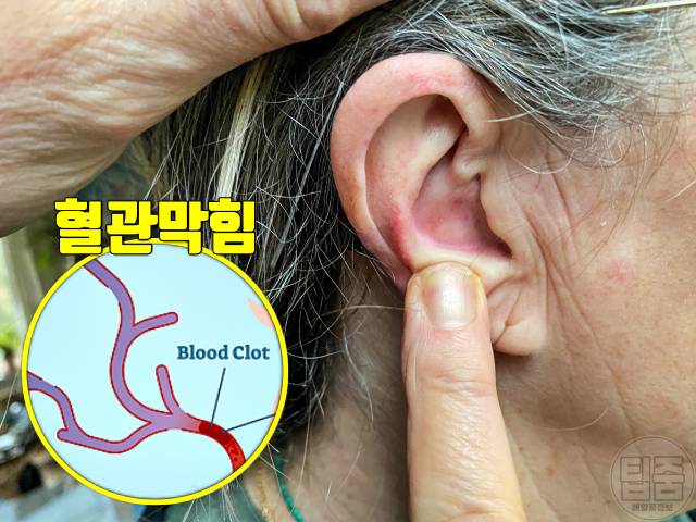 귓불주름 귓볼주름 뇌졸중 전조증상 귓볼이 접히는 증상
