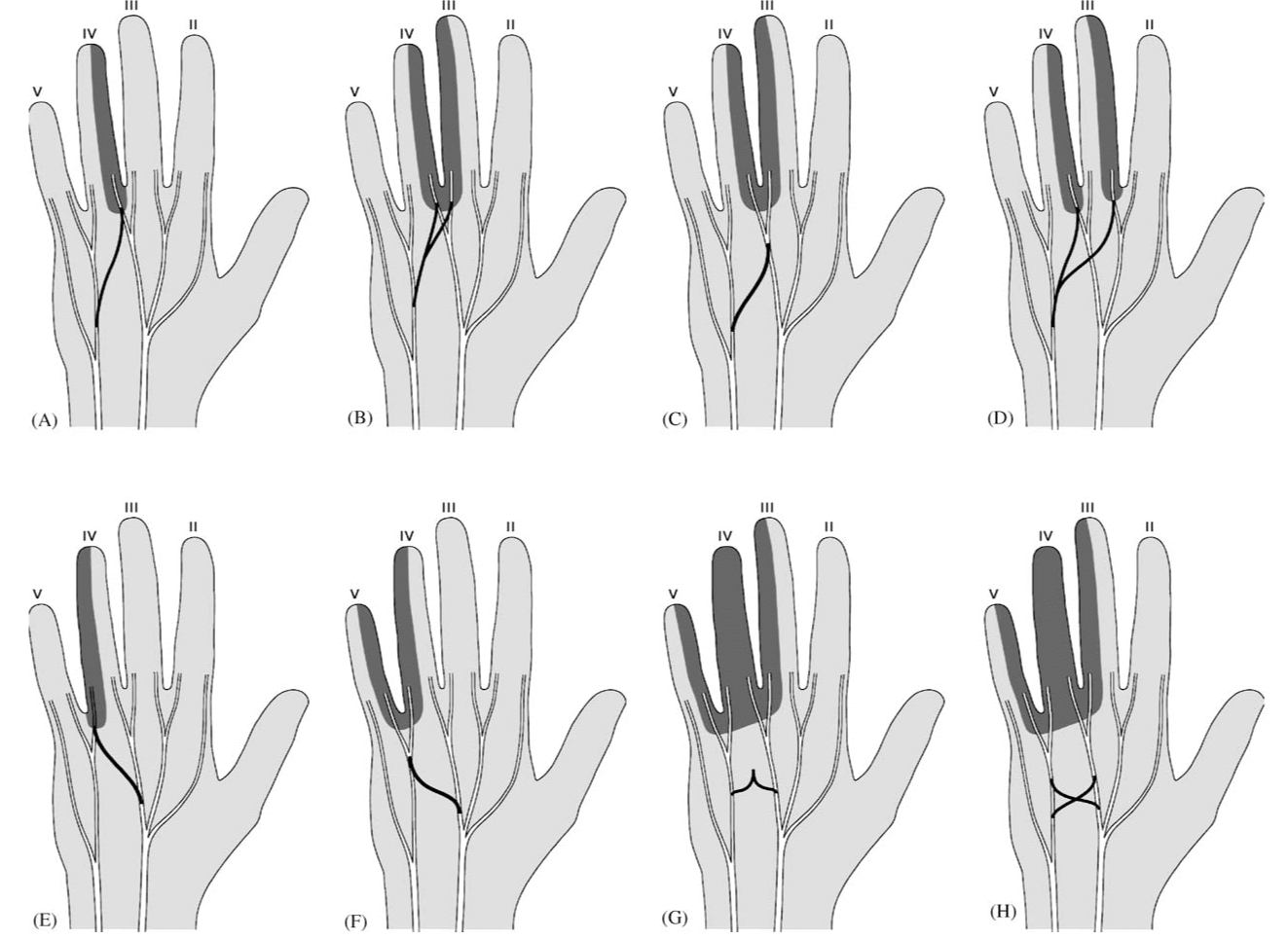 정중신경의 다양한 변이들