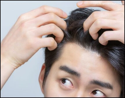 젊은-나이에-새치