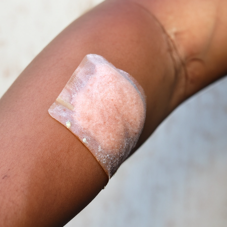 화상물집-치료방법