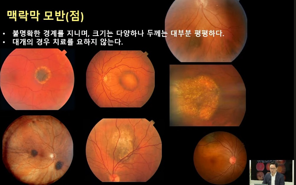 안구종양-안과-김민-교수