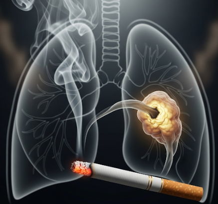 흡연으로 인한 폐의 손상을 의미하는 이미지