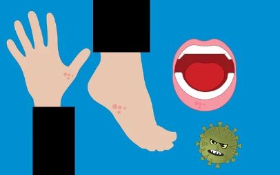 대상포진 초기증상