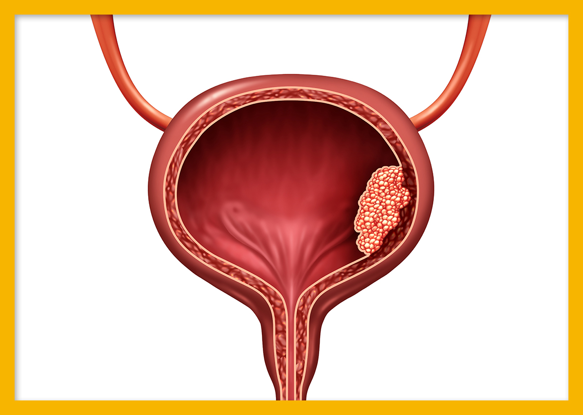 방광암 생존율, 방광암 초기증상
