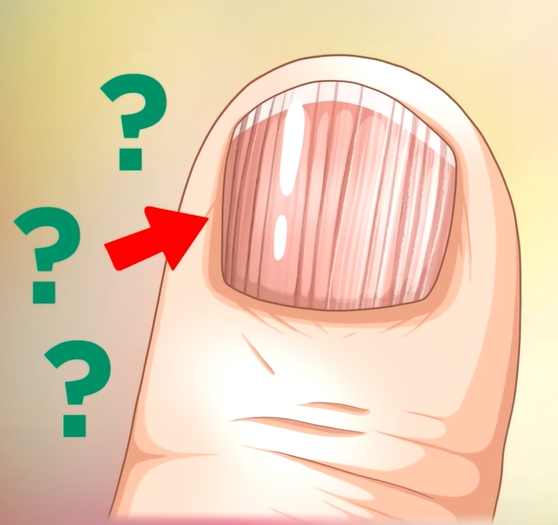 손톱에 세로줄이 생기는 이유