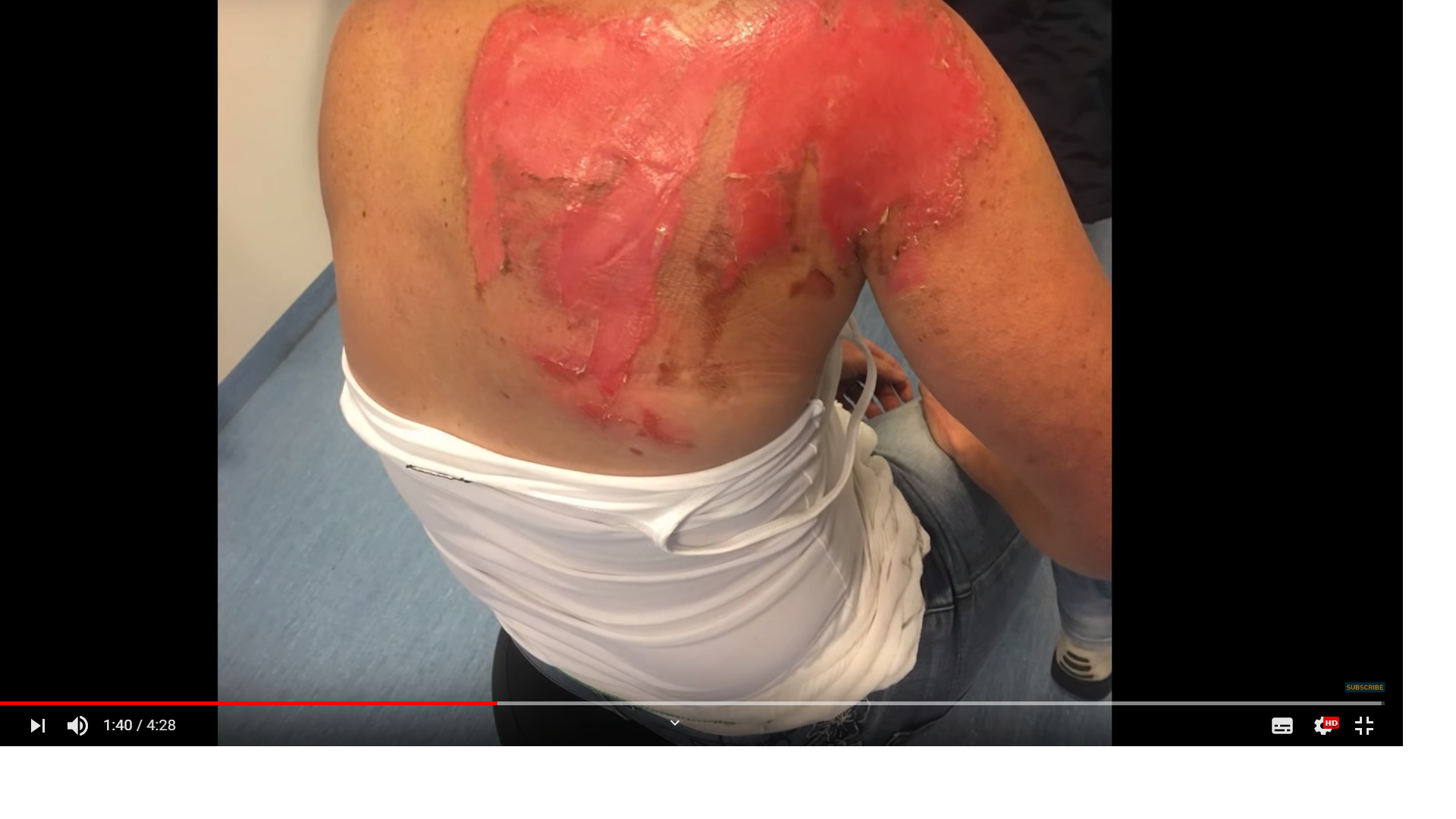 윔호프호흡법효과-화상치료-전