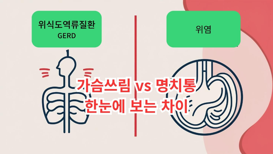 역류성 식도염은 가슴 뒤 타는 느낌과 신물 역류, 위염은 명치 통증과 메스꺼움이라는 차이를 아이콘으로 비교한 인포그래픽 썸네일 이미지