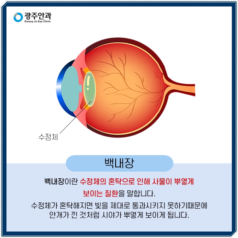 백내장 증상