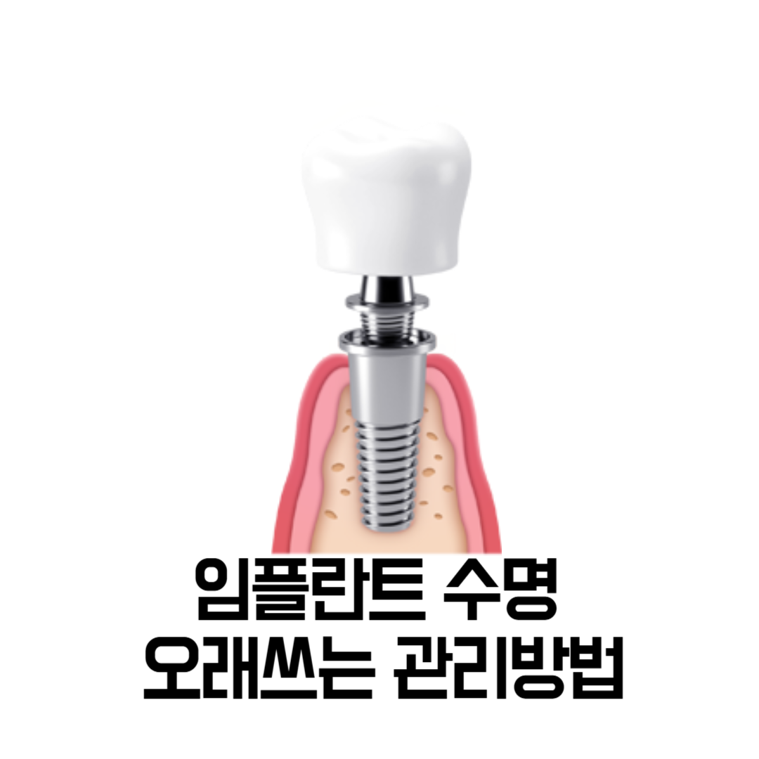 임플란트 수명 오래쓰는 관리방법