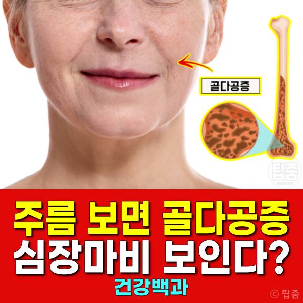 얼굴주름 골다공증 팔자주름 귓볼주름 심장마비