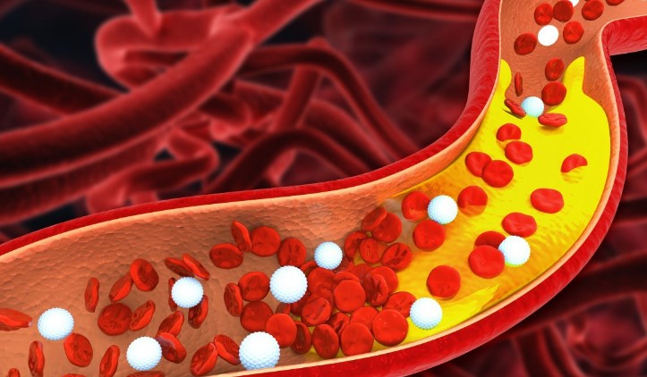 이상지질혈증-고지혈증-원인-치료법-진단기준