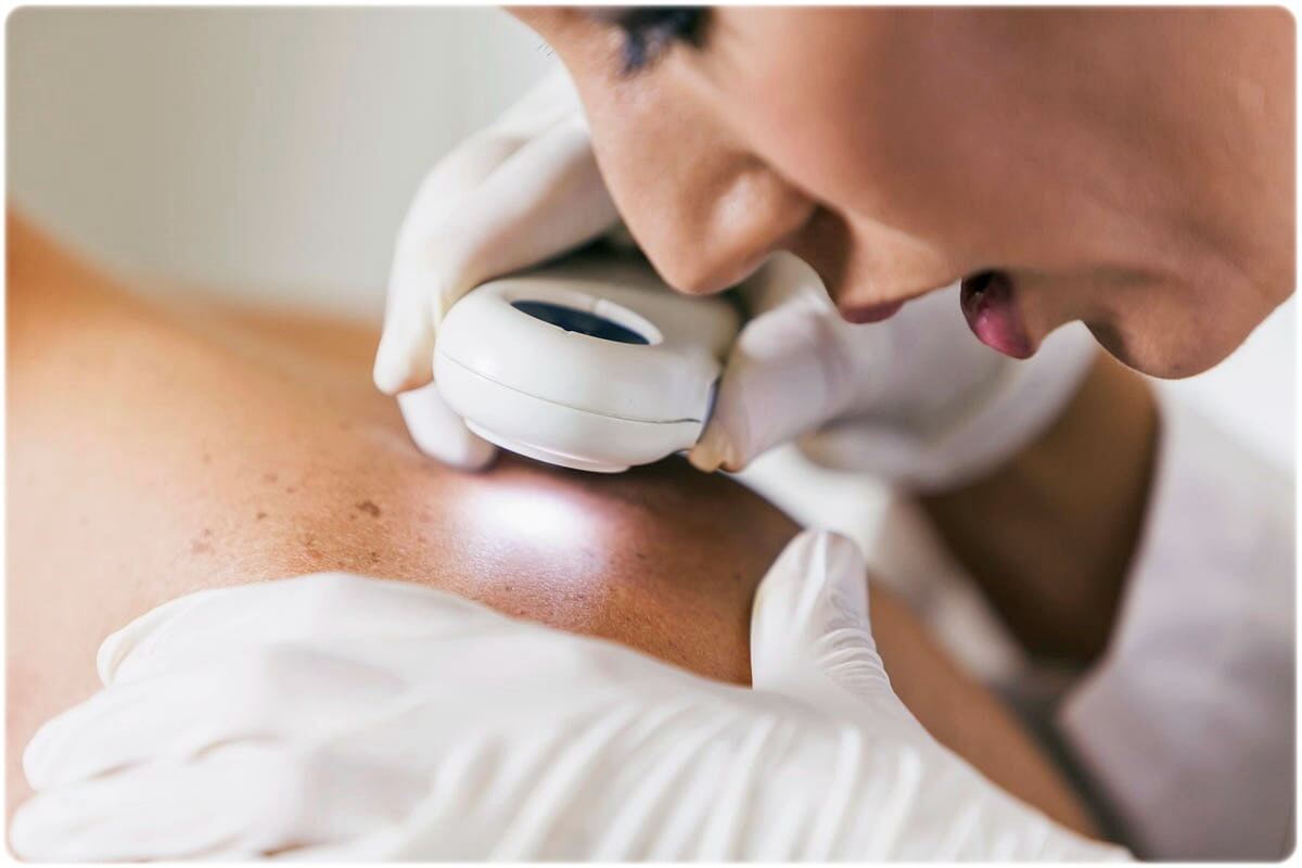 피부암 초기증상 원인 종류 진단 및 치료 방법 예방 방법