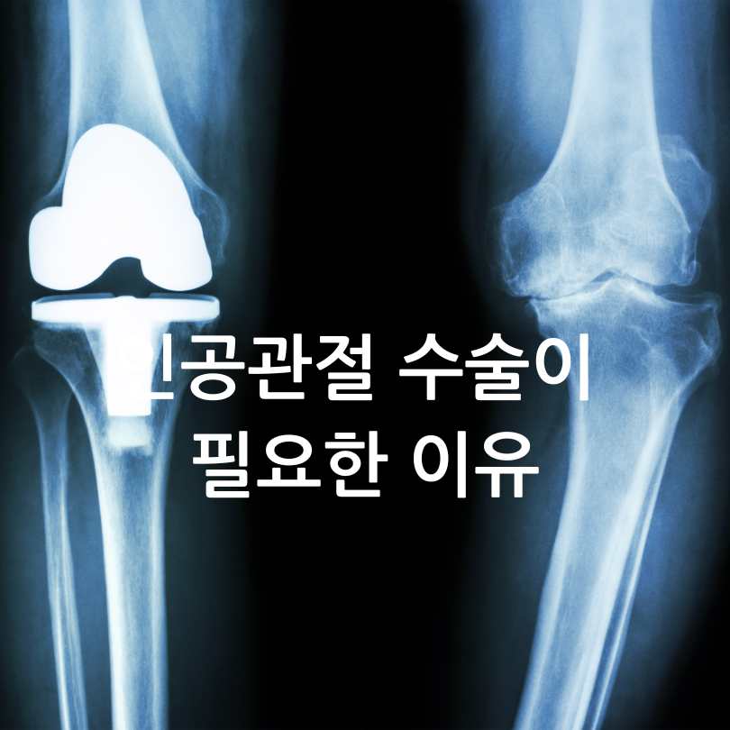 인공관절 수술비지원사업