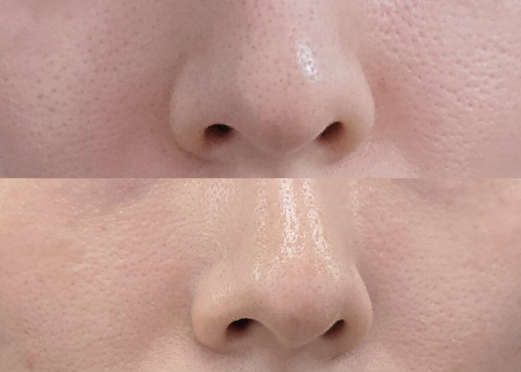 모공 관리로 인해 모공이 줄어든 모습