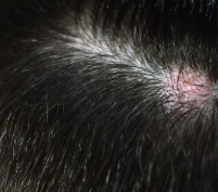 지루성 두피염 증상2