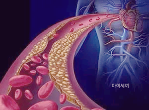 높은 콜레스테롤