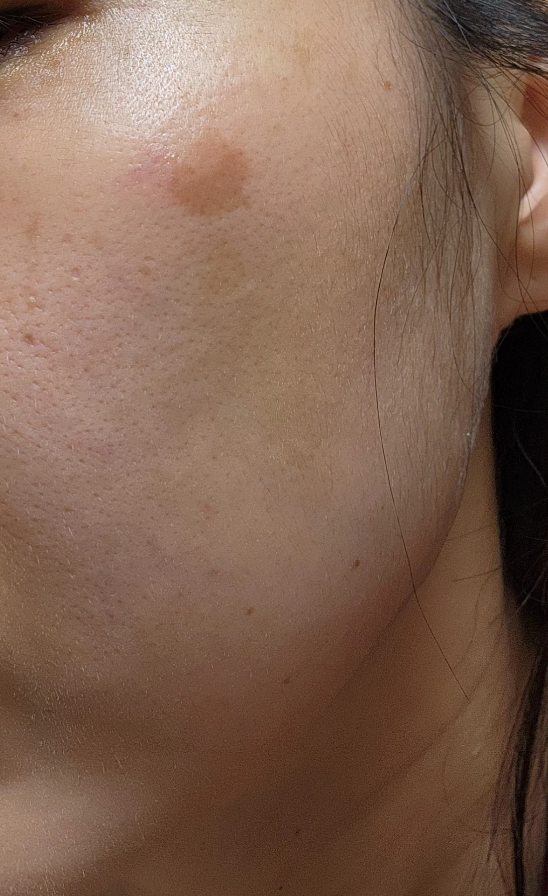 흑자치료전 얼굴 피부 사진 우