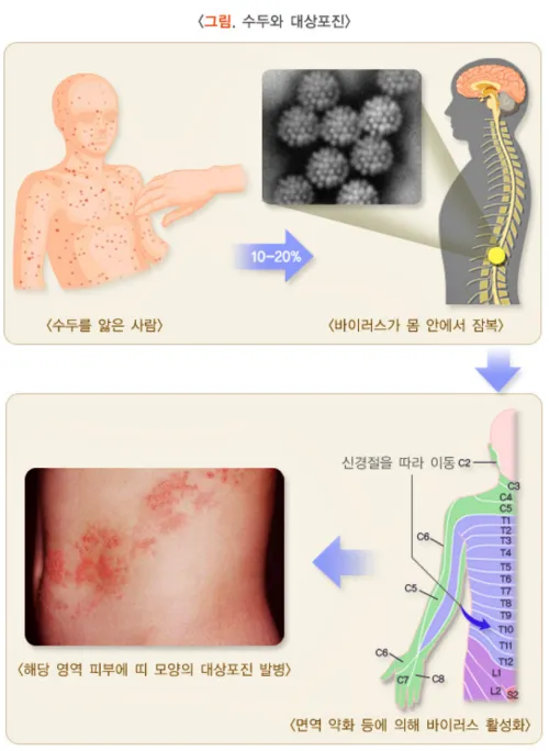 수두와 대상포진 바이러스 연관성