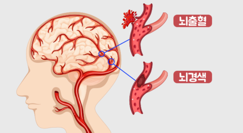 cerebral infarction and cerebral hemorrhage