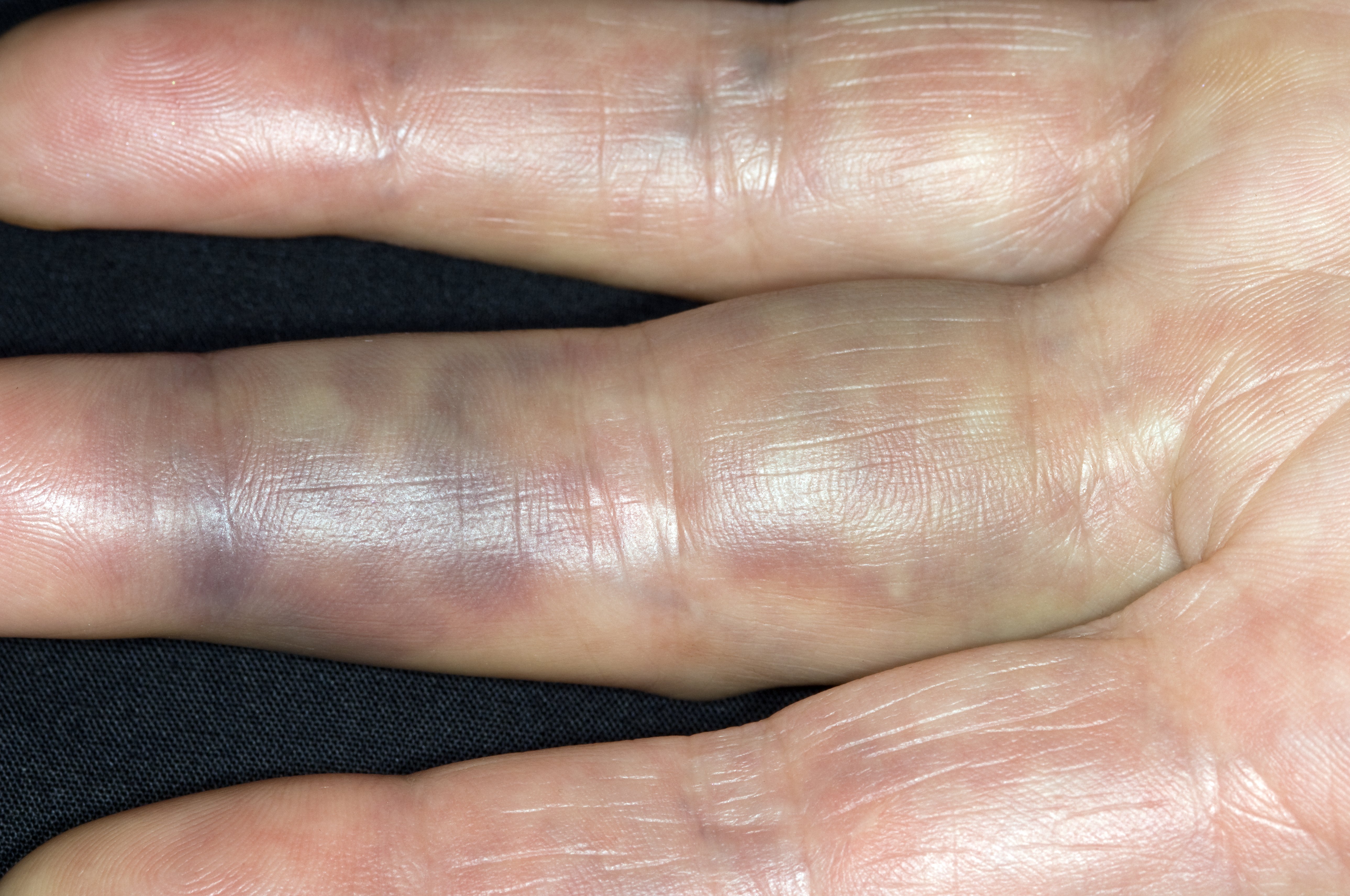 손가락이 골절된 사진