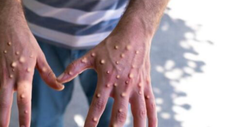 엠폭스-증상사진-감염경로