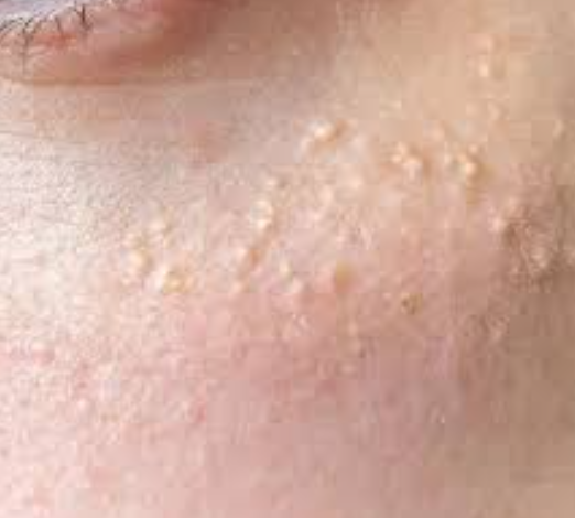 비립종 생기는 이유