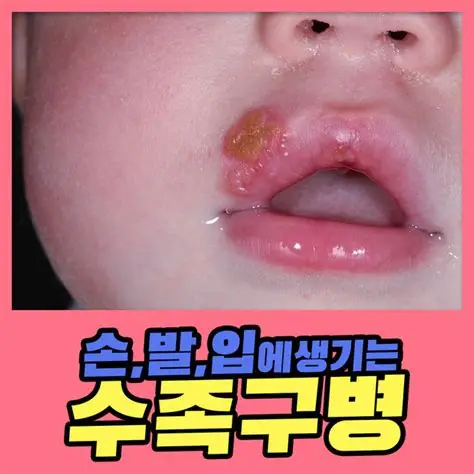 손, 발, 입에 생기는 수족구병