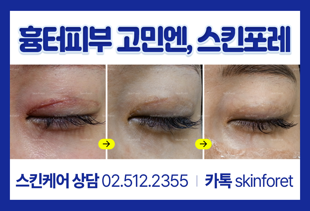 눈 흉살과 쌍꺼풀 흉살 개선 전후 이미지