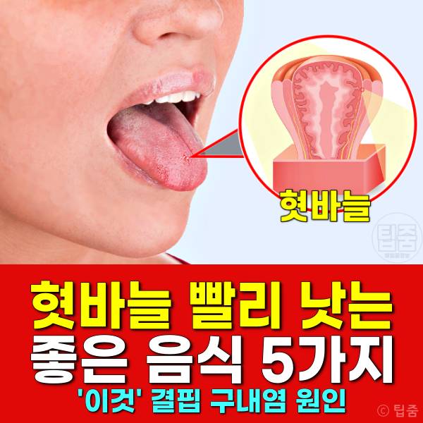 혓바늘 치료 빨리 낫는 법,구내염에 좋은 음식