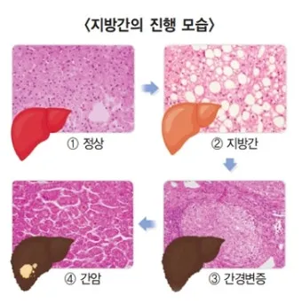 비알콜성 지방간 없애는 방법 운동 식단 중심 회복법 정리_14
