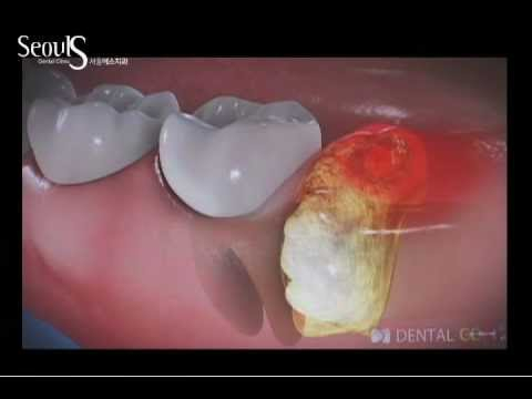 사랑니 발치 후 식사 가이드