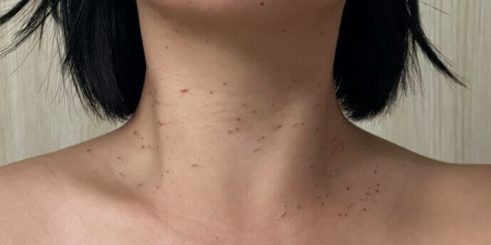 쥐젖 제거 후 상처