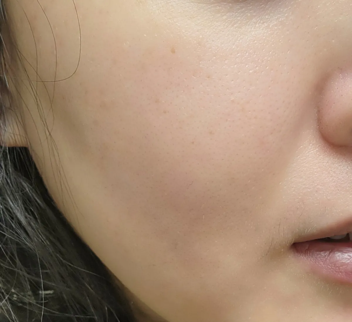 주사피부염-완치-후-피부-상태