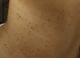 편평사마귀 없애는 방법