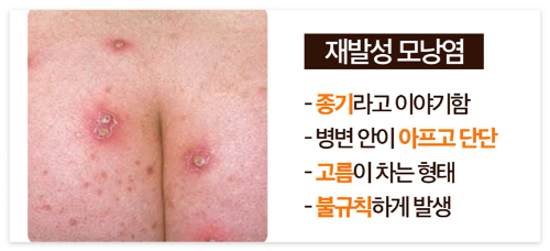재발성 모낭염